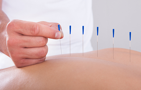 Akkupunktur, Therapeut setzt Nadeln in Rücken