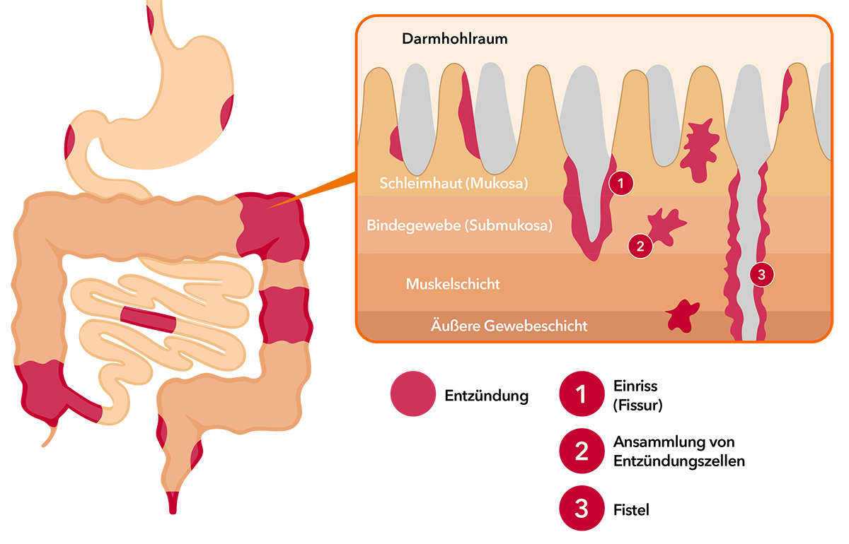 Grafik, Einblick in den Darm