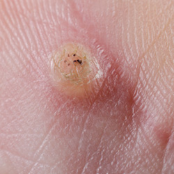 Gewöhnliche Warzen oder Stachelwarzen treten meist an Händen und Fingern auf