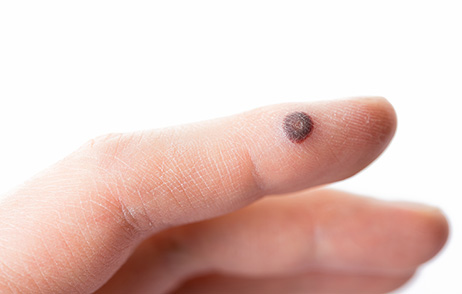 Warze auf Finger