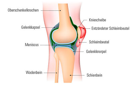 entzündeter Schleimbeutel im Knie Abbildung von einem entzündetem Schleimbeutel im Knie
