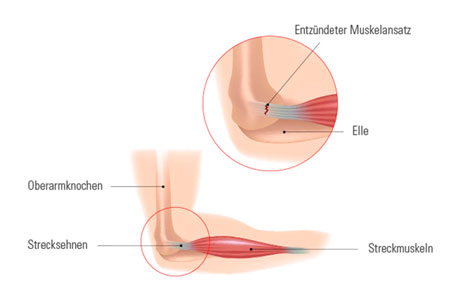 Tennisarm Abbildung eines Ellenbogens mit Bezeichnungen