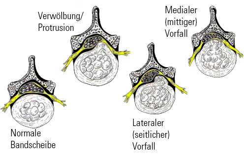 Bandscheiben gesund-und-krank